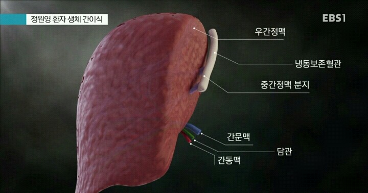 간이식수술 방법.jpg | 인스티즈