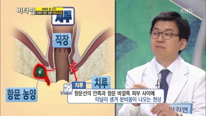 항문이 간지럽다면? | 인스티즈